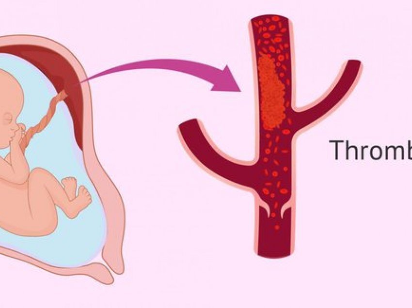 Rreziku i trombofilisë dhe trombozës në shtatzëni