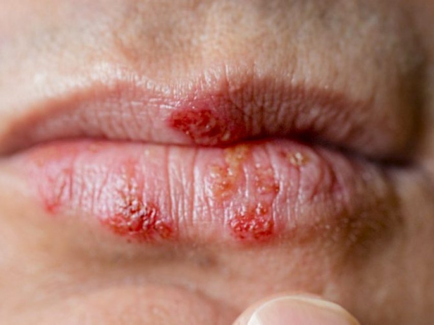 Pse shfaqet herpsesi në buzë? Metodat si ta parandaloni dhe trajtoni