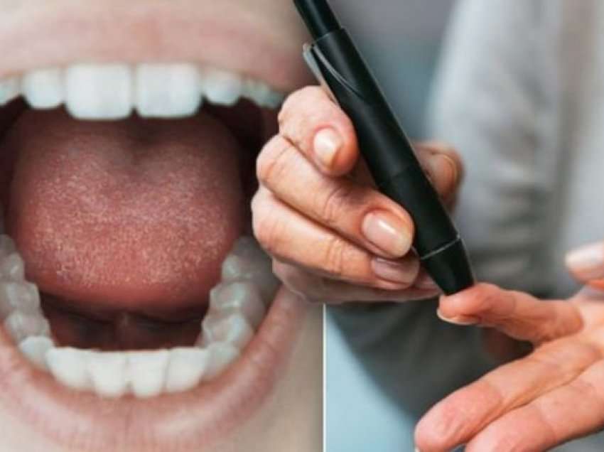Simptomat e diabetit në gojë që nuk duhet t’i injoroni kurrë