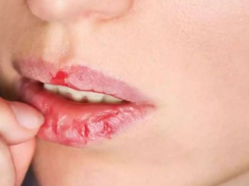 Buzët e plasaritura mund të tregojnë një gjendje serioze, kur duhet të shqetësoheni