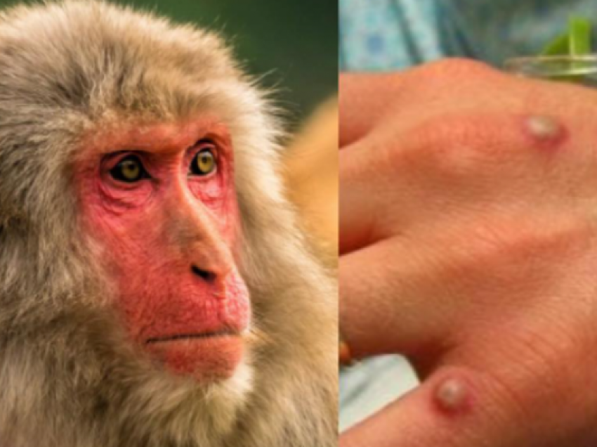 U infektua me linë e majmunit, vdes turisti italian