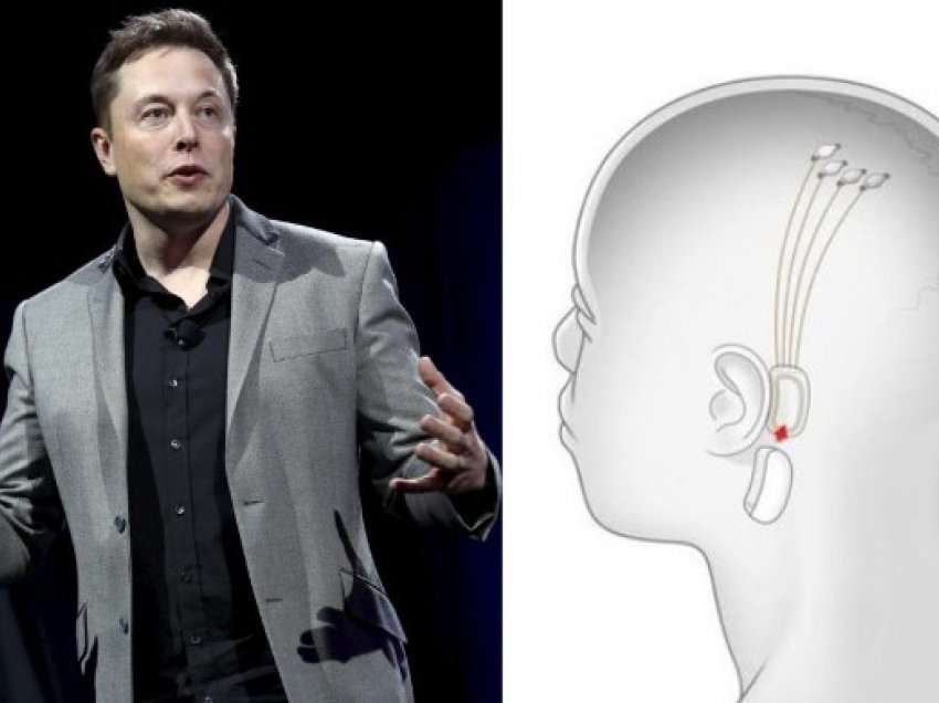 Mikroçip në trurin e njeriut, Elon Musk premton të “pamundurën”