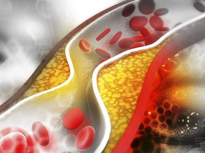 Kolesteroli i lartë në rini mund të lidhet me çështjet shëndetësore në pleqëri