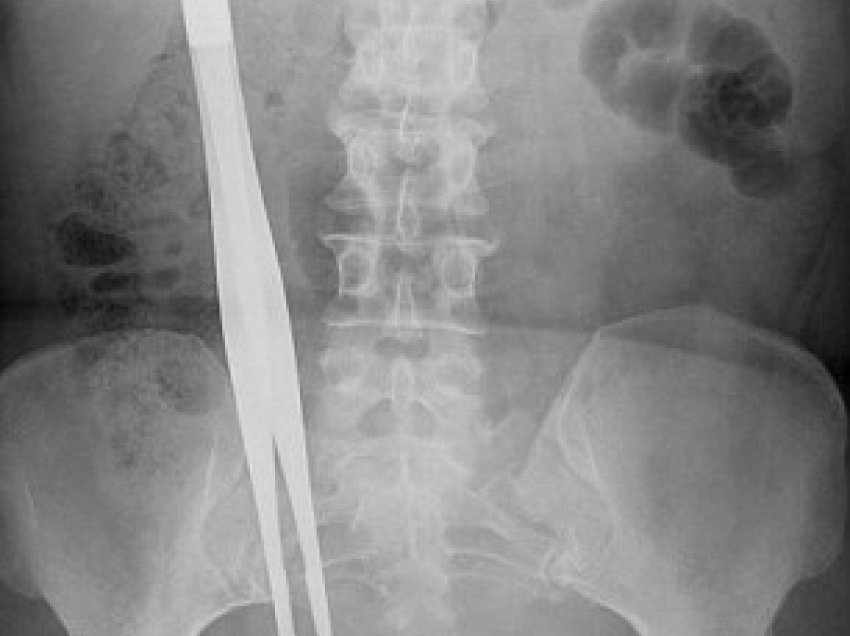 Operacioni zgjati 7 orë, mjekët harrojnë pincat metalike brenda barkut të pacientit