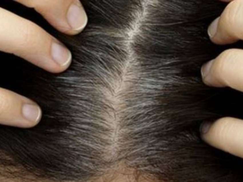 Disa produkte shtëpiake që ndihmojnë të hiqni qafe flokët e thinjur