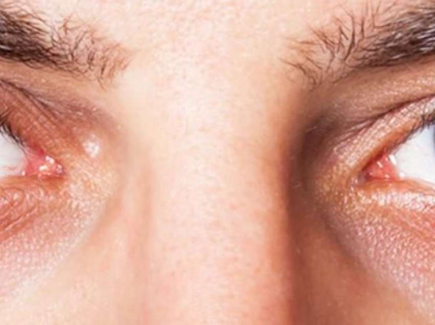 Si të shmangni shenjat e plakjes rreth syve