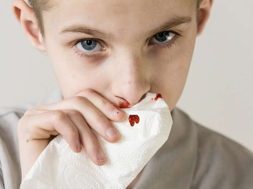 A mund të shkaktojë moti i nxehtë gjakderdhje nga hundët dhe sa e rrezikshme është?