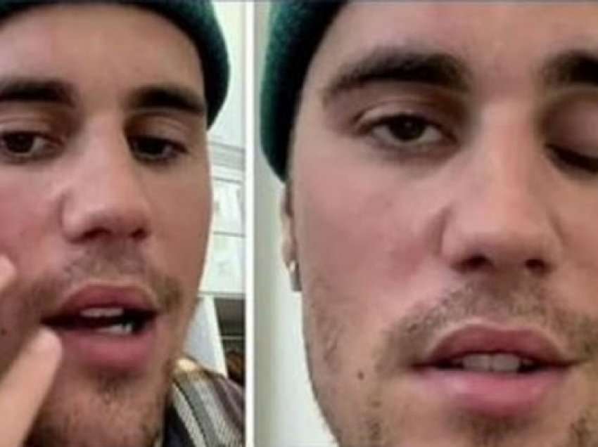 ​Justin Bieber zbulon paralizën e fytyrës pas anulimit të shfaqjeve