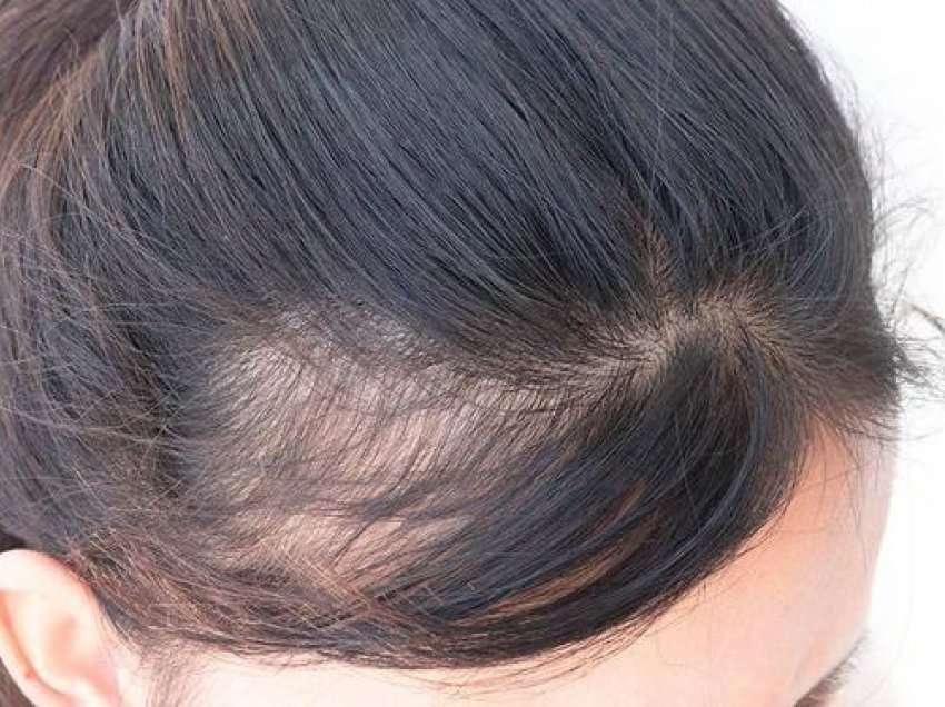 Rënia e flokëve është një problem kronik?