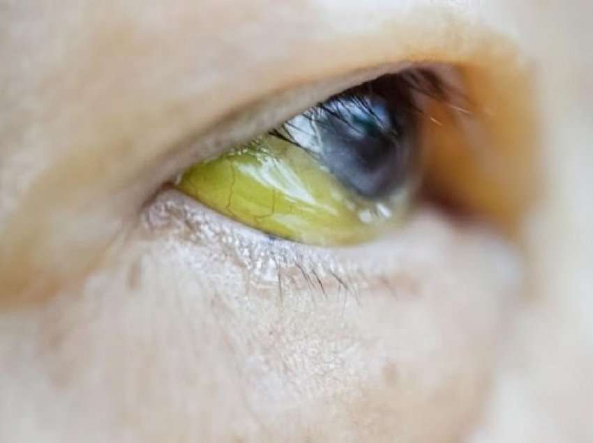 ​Çfarë e shkakton rrjedhjen e verdhë nga sytë?