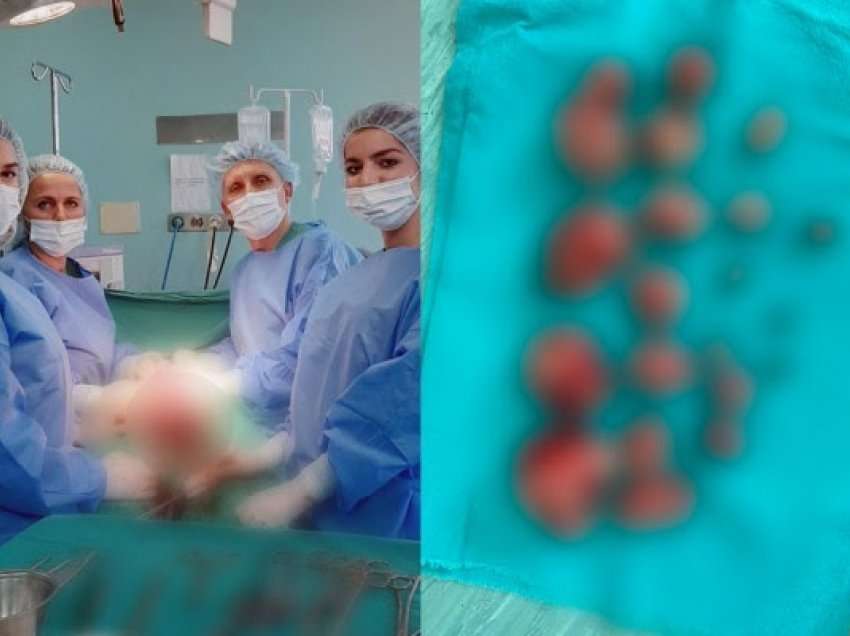 ​Operacion i komplikuar në ShSKUK, pacientes i hiqen 21 miomë