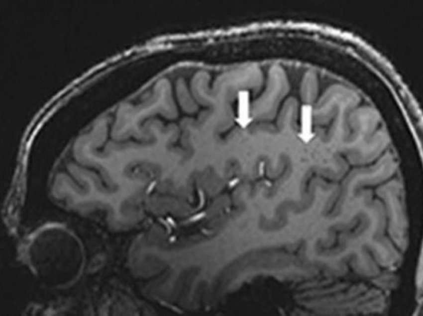 ​Ndryshime misterioze të trurit zbulohen te njerëzit me migrenë