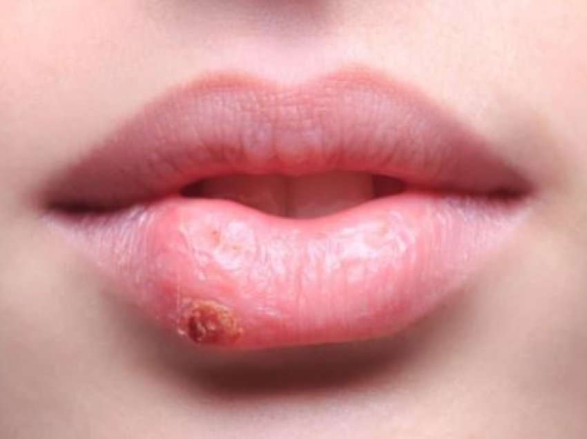 Keni herpes në buzë: Çfarë po ndodh në organizmin tuaj?