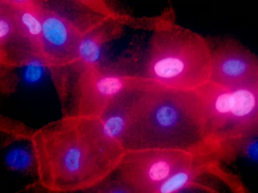 Rrezatimi me protone testohet tek gratë me kancer gjiri me rrezikshmëri të lartë 