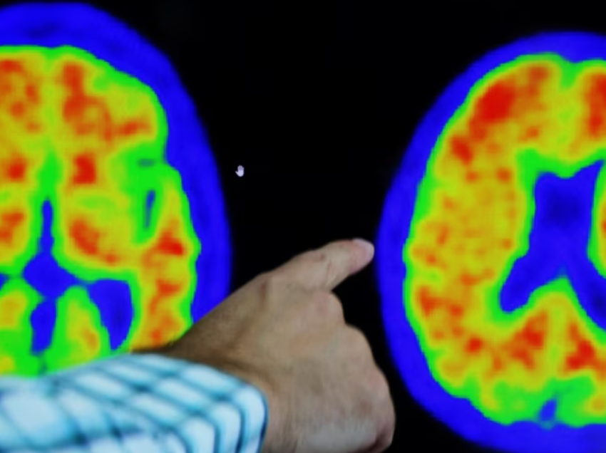 Si arrijnë disa njerëz t’i shpëtojnë trashëgimisë gjenetike të sëmundjes Alzheimer?
