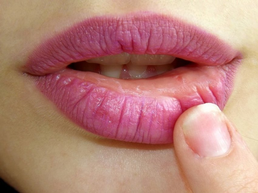 Mënyra natyrale për të shëruar herpesin e buzës