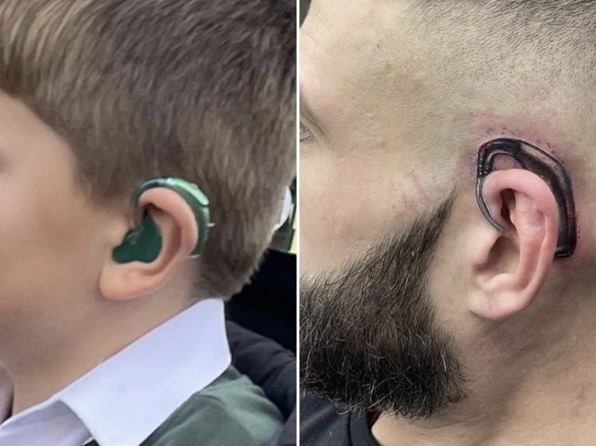 Djali lind me humbje të pjesshme dëgjimi, babai bën tatuazh aparatin në vesh