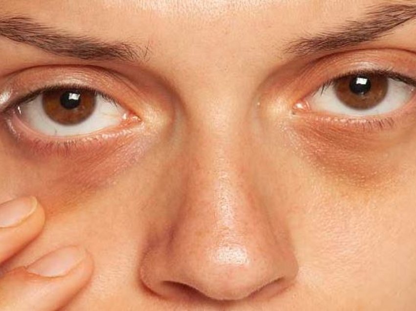 Pesë lëndë ushqyese mrekullibërëse për reduktimin e rrathëve të zinj poshtë syve