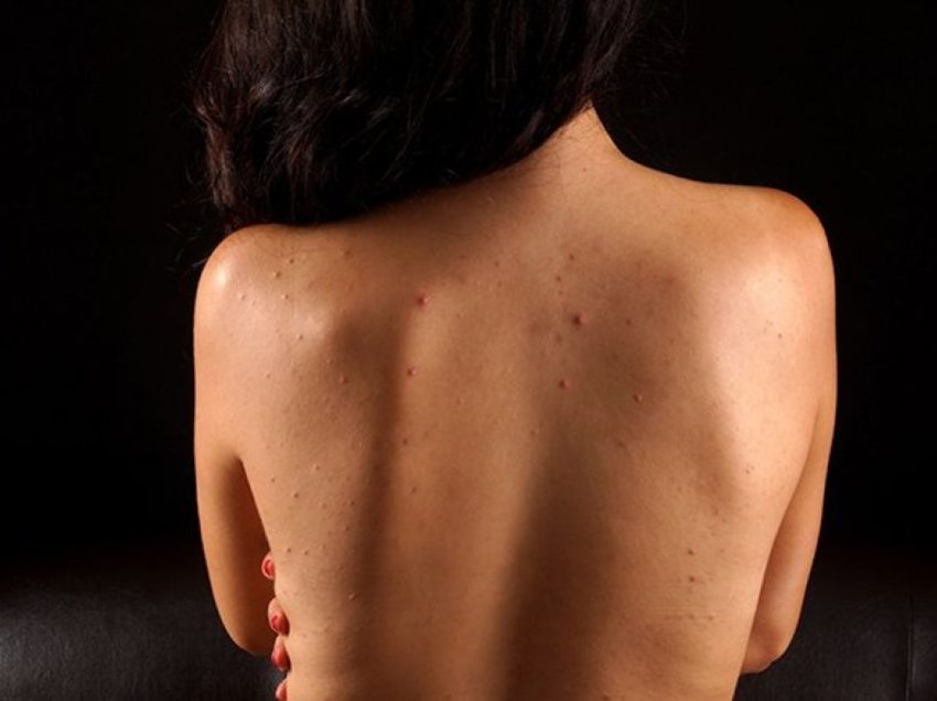 Dermatologia e Kendall Jennerit zbulon: Ja se si njëherë e përgjithmonë t’i eliminoni aknet nga shpina!