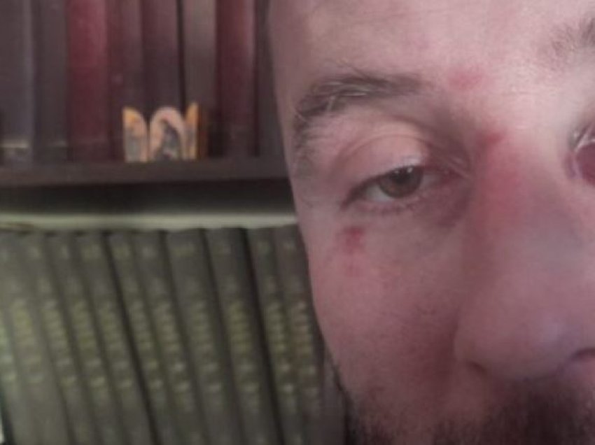 Një qytetar serb pretendon se është rrahur pasi ka ofenduar Vuçiqin