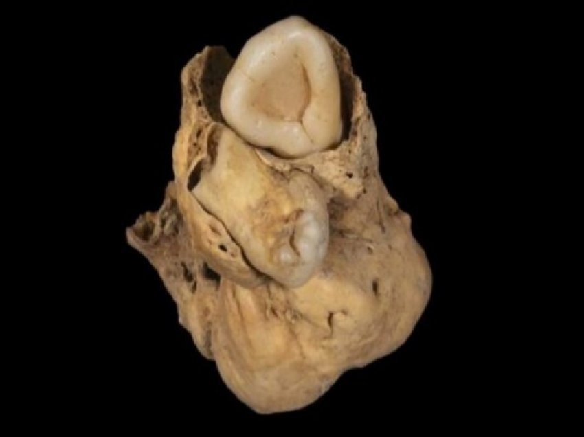 ​Tumori i çuditshëm me dhëmbë u gjet në trupin e një gruaje egjiptiane