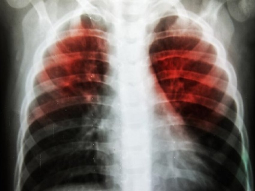 ​Zbulohet pse tuberkulozi është rezistues në rritje ndaj barnave