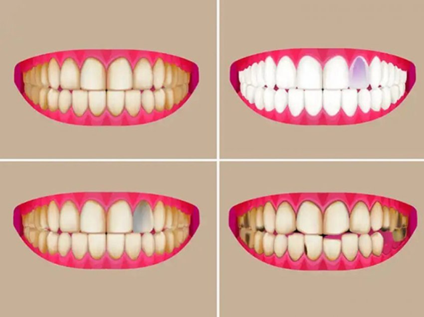 Çfarë mund të zbulojë ngjyra e dhëmbëve për shëndetin tuaj – dhe kur duhet të shqetësoheni?