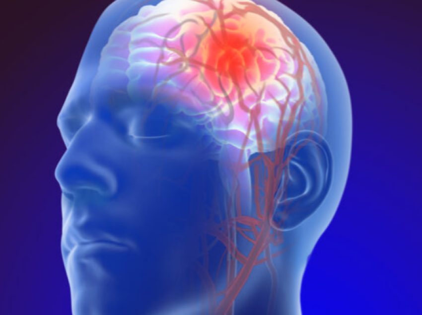 Shkaqet që mund të sjellin në zhvillimin e aneurizmit të trurit