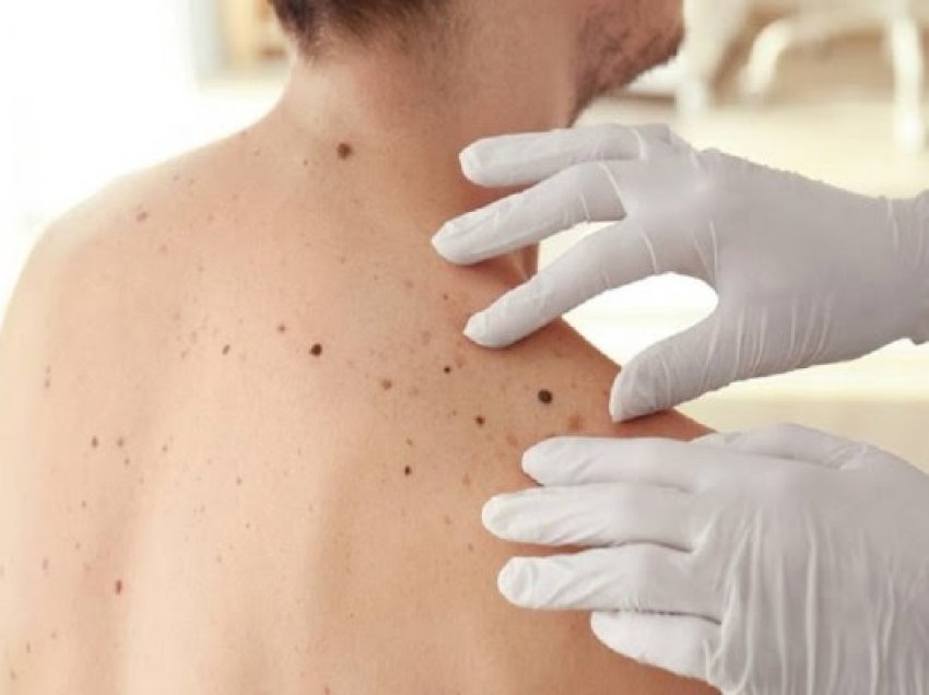 ​Hulumtimi: Forma më vdekjeprurëse e kancerit të lëkurës nuk është melanoma