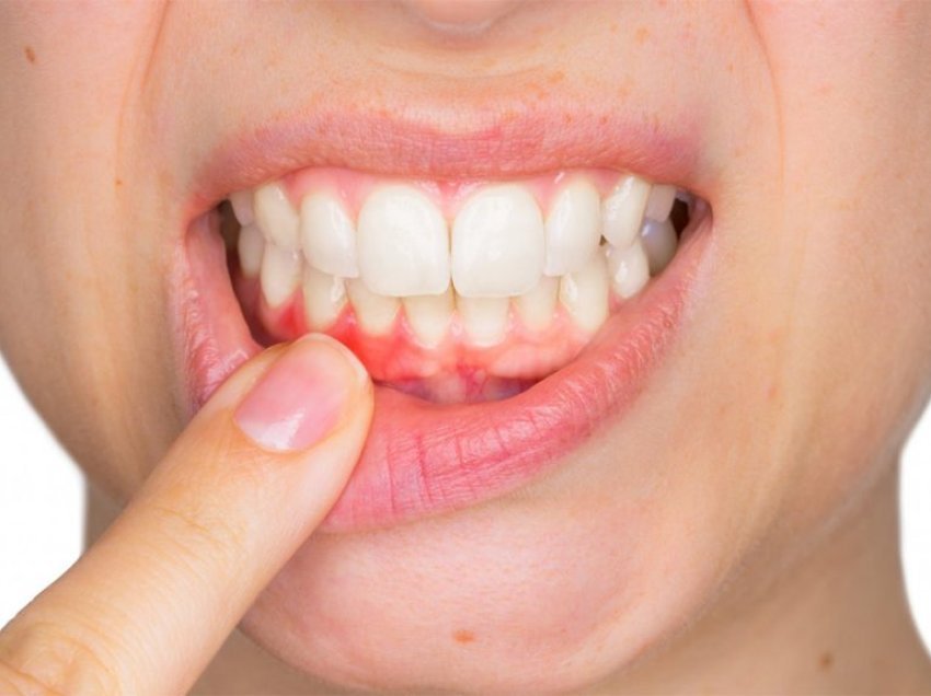 Sëmundja që shkakton rënien e dhëmbëve, kujdesi që ju duhet