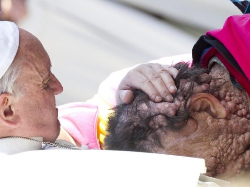 ​Vdes njeriu me fytyrë të deformuar që Papa e përqafoi më 2013