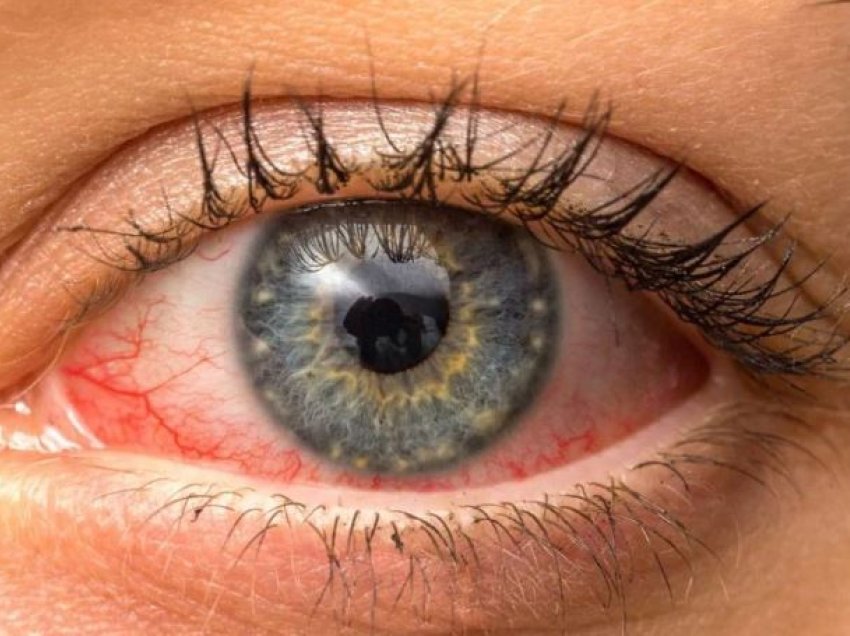 Problemet që shkakton celulari, si të kujdeseni për tharjen e syve